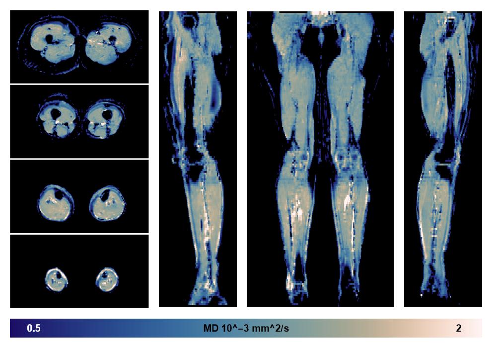 IVIM corrected whole leg muscle mean diffusivity obtained from diffusion tensor imaging.